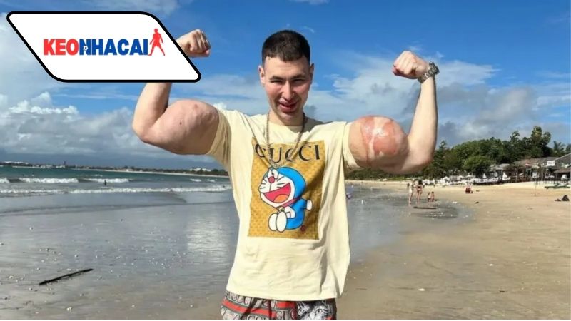 nghe-si-the-hinh-nga-nguy-co-mat-ca-hai-tay-vi-lam-dung-hoa-chat Nghệ sĩ thể hình Nga nguy cơ mất cả hai tay vì lạm dụng hóa chất